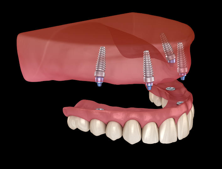 All on 4 upper bridge; dental implants; Natural Fit Dentures & Denture Care