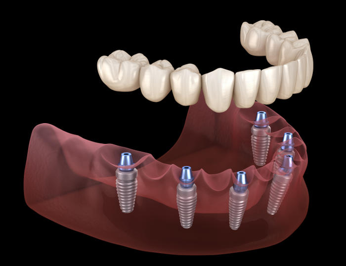 Mandibular prosthesis All on 6 implants; medically accurate 3D illustration of dentures