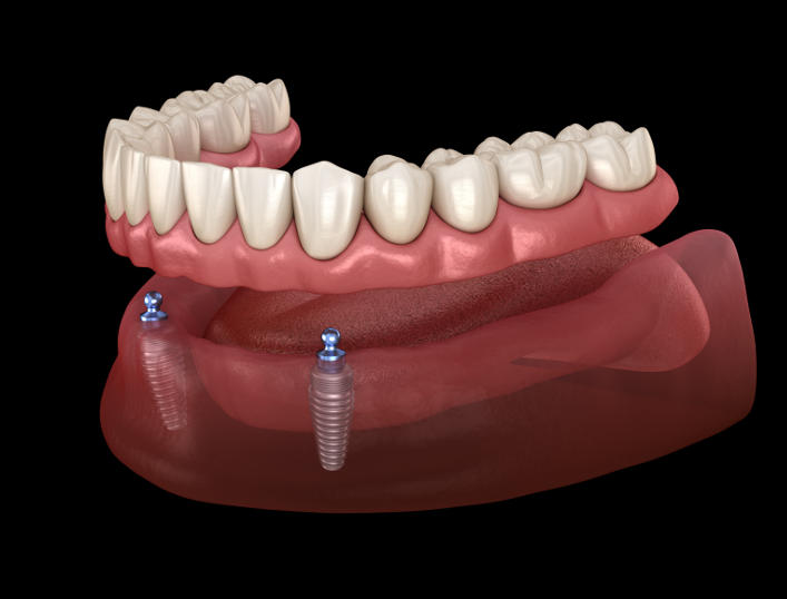Mandibular removable prosthesis All on 2 system supported by implants with ball attachments